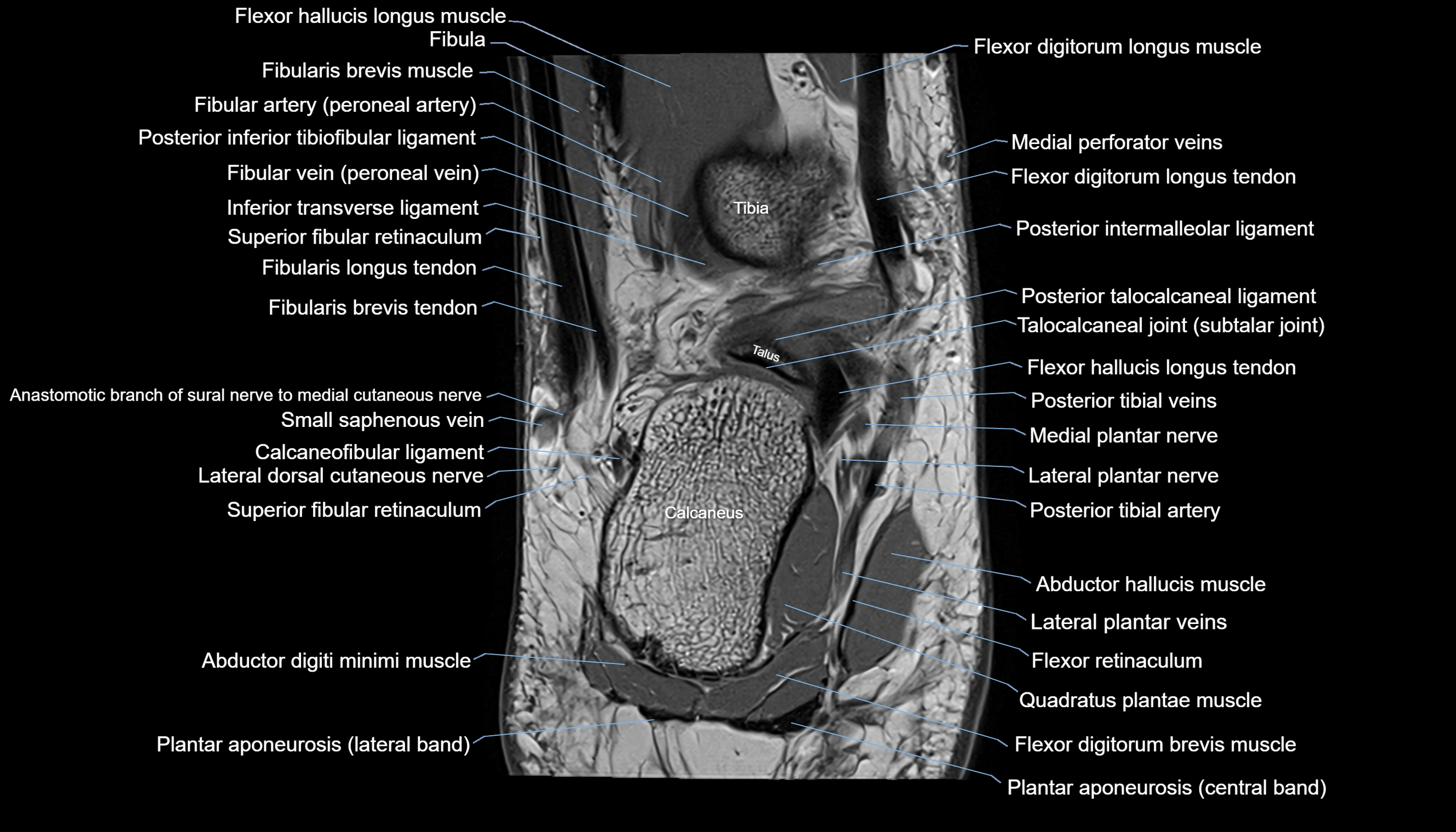 Ankle coronal anatomy 3T MRI images -img-11001-00019.webp